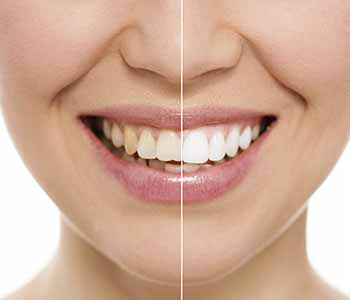In Office And Take Home Teeth Whitening Options For Patients Of Woodbridge Dental Practice