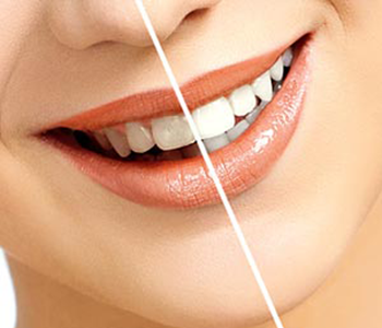 Where can I find laser teeth whitening near me in Woodbridge, ON?