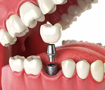 The Process of Getting Dental Implants in Woodbridge to Restore Your Smile