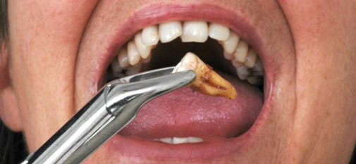 Tooth Extractions Aliso Viejo - Tooth Extractions