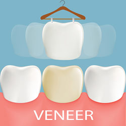 <?php echo $pk;?> - Veneers