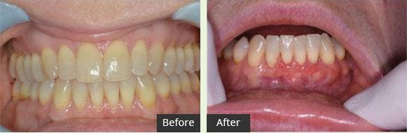 Before and After Connective tissue Graft lower Mand. Ant.