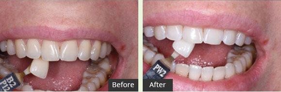 Before and After Laser Whitening