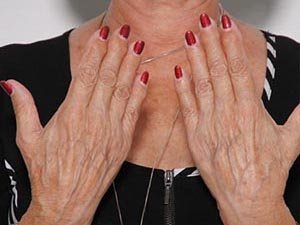 Fillers Before Image