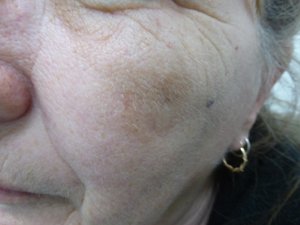 Lumecca IPL - 2 treatments After Image 01