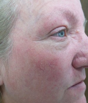 Lumecca IPL - 3 treatments After Image Case 05