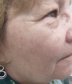 Lumecca IPL - 3 treatments After Image 06