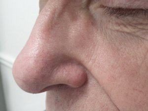 Lumecca IPL - 2 treatments 02