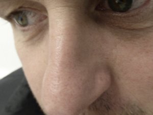 Lumecca IPL - 3 Treatments After Image Case 03