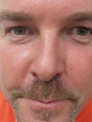 Lumecca IPL - 3 treatments After Image 07