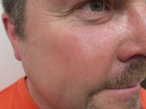 Lumecca IPL - 3 Treatments After Image Case 04