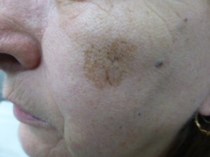 Lumecca IPL - 2 treatments Before Image 01