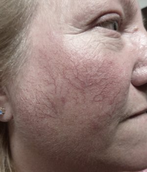 Lumecca IPL - 3 treatments Before Image Case 05