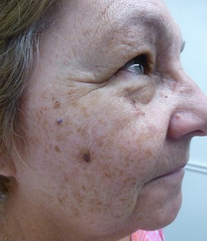 Lumecca IPL - 3 treatments Before Image 06