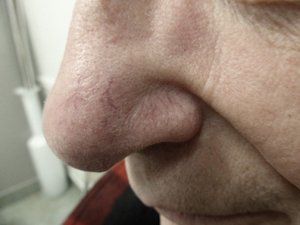 Lumecca IPL - 2 treatments Before Image 02