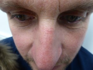 Lumecca IPL - 3 Treatments Before Image Case 03