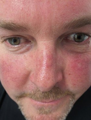 Lumecca IPL - 3 treatments Before Image 07