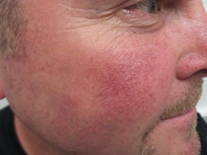 Lumecca IPL - 3 Treatments Before Image Case 04