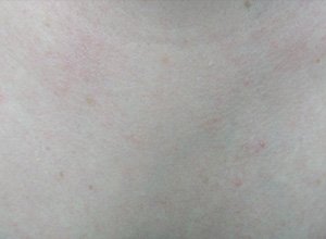 Treated telangiectasia After Image 01