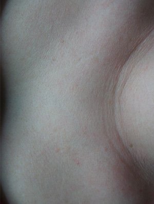 Treated telangiectasia After Image 03