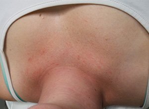 Treated telangiectasia Before Image 02