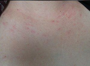 Treated telangiectasia Before Image 01