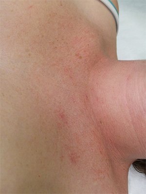 Treated telangiectasia Before Image 03