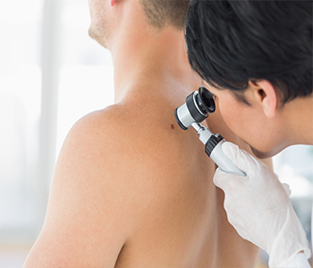 Removal of skin tags Hamilton Ontario