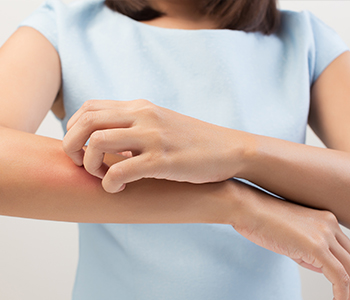 Treatment for Psoriasis