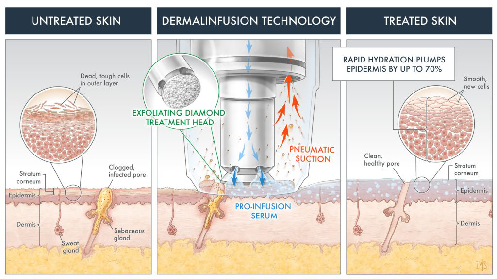 skin with SilkPeel microdermabrasion treatments by Dr. Rahul Shukla