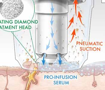 Achieve beautiful skin with SilkPeel microdermabrasion treatments in Hamilton, ON