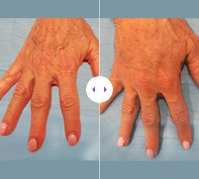 Hyaluronic Acid Filler