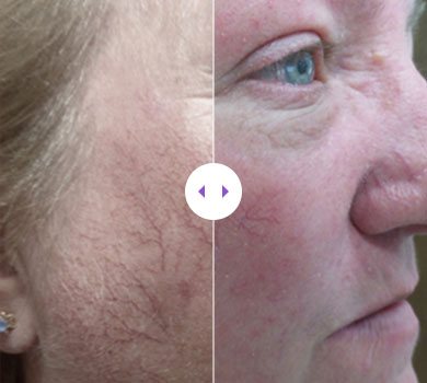 Lumecca IPL – 3 Treatments