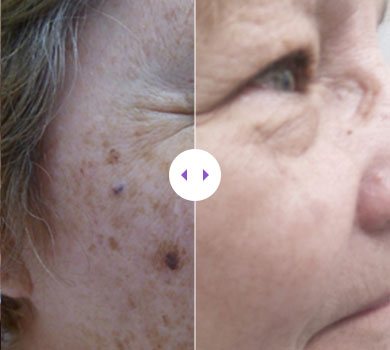 Lumecca IPL – 3 Treatments