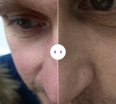 Lumecca IPL – 3 Treatments