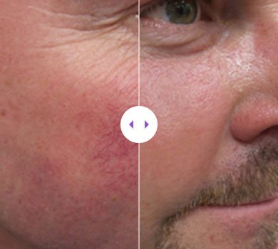 Treated telangiectasia