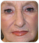 Dermatologist Rancho Cucamonga - After Image 03
