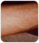 Dermatologist Rancho Cucamonga - After Image 05