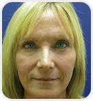 Dermatologist Rancho Cucamonga - After Image 01