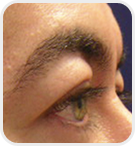 Dermatologist Rancho Cucamonga - Before Image 02