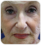 Dermatologist Rancho Cucamonga - Before Image 03