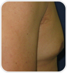 Dermatologist Rancho Cucamonga - Before Image 04