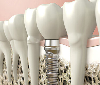 Dr. Theodore M. Siegel, Big Smile Dental Providing Missing Teeth With Dental Implants
