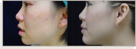 Photo Gallery Fountain Valley - For the Asian Face Image 01