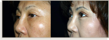 Photo Gallery Fountain Valley - For the Asian Face Image 11