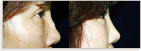 Photo Gallery Fountain Valley - For the Asian Face Image 12