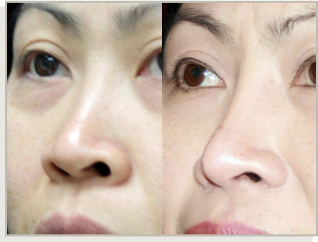 Photo Gallery Fountain Valley - For the Asian Face Image 13