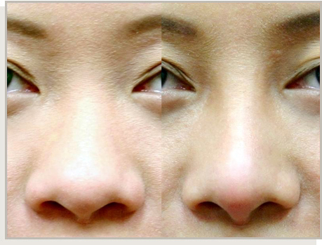 Photo Gallery Fountain Valley - For the Asian Face Image 16