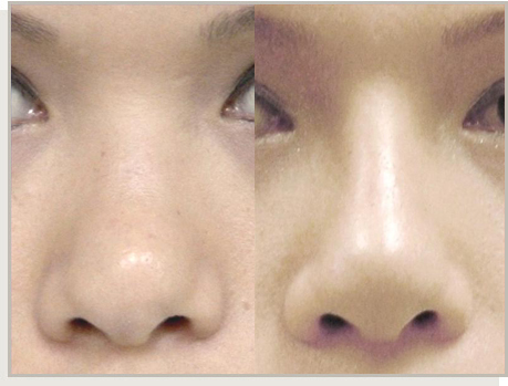 Photo Gallery Fountain Valley - For the Asian Face Image 17