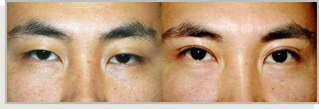Photo Gallery Fountain Valley - For the Asian Face Image 02